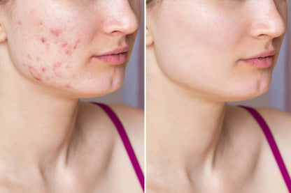 Serum Niacinamida the Ordinary ¡luce una piel más sana y linda!